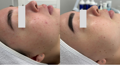 Авторский пилинг Анти-акне 2